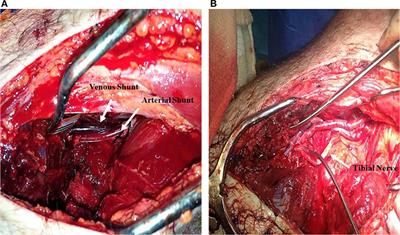 Vascular Shunts in Civilian Trauma